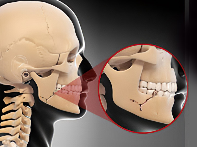 Maxillofacial Fractures services