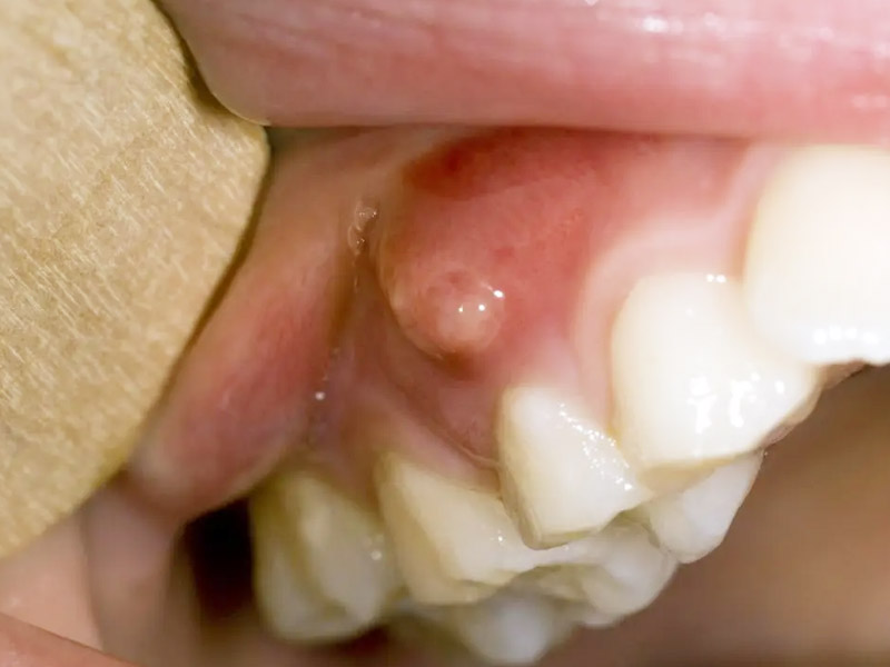 close-gum-cyst-purulent-flux-disease