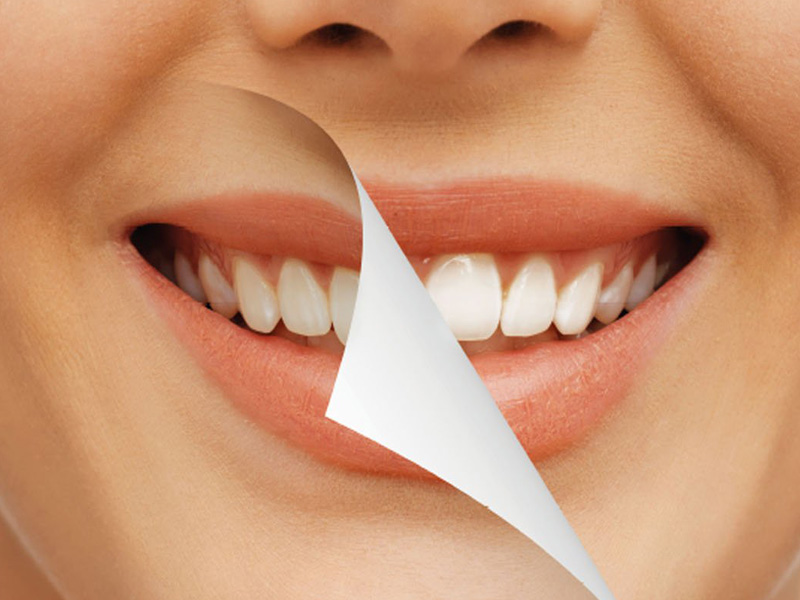 teeth whitening aervices